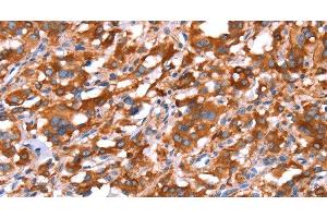 Immunohistochemistry of paraffin-embedded Human thyroid cancer tissue using GAS8 Polyclonal Antibody at dilution 1:40 (GAS8 antibody)