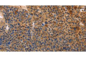Immunohistochemistry of paraffin-embedded Human liver cancer tissue using MUSK Polyclonal Antibody at dilution of 1:30 (MUSK antibody)