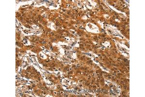Immunohistochemistry of Human gastic cancer using DEAF1 Polyclonal Antibody at dilution of 1:40 (DEAF1 antibody)