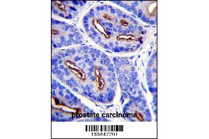 FOLH1 Antibody immunohistochemistry analysis in formalin fixed and paraffin embedded human prostate carcinoma followed by peroxidase conjugation of the secondary antibody and DAB staining. (PSMA antibody  (N-Term))