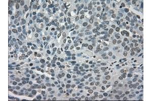 Immunohistochemical staining of paraffin-embedded Adenocarcinoma of breast tissue using anti-LDHA mouse monoclonal antibody. (Lactate Dehydrogenase A antibody)
