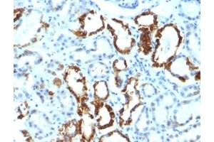 FFPE human renal cell carcinoma tested with Lactadherin antibody (EDM45) (MFGE8 antibody)