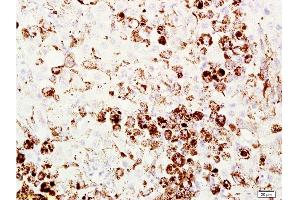 Formalin-fixed and paraffin embedded mouse melanoma labeled with Anti-Melanoma HMB45/Melanoma/Melan-A/MART-1 Polyclonal Antibody, Unconjugated  at 1:200 followed by conjugation to the secondary antibody and DAB staining. (MLANA antibody  (AA 51-118))