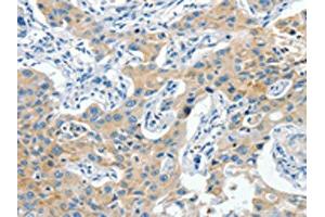 The image on the left is immunohistochemistry of paraffin-embedded Human lung cancer tissue using ABIN7190319(CNTNAP3 Antibody) at dilution 1/40, on the right is treated with synthetic peptide. (CNTNAP3 antibody)