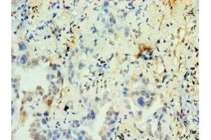 Immunohistochemistry of paraffin-embedded human lung cancer using ABIN7161904 at dilution of 1:100 (TR4 antibody  (AA 240-380))