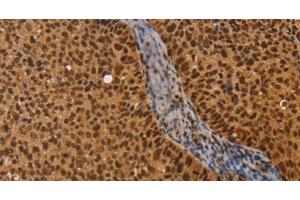 Immunohistochemistry of paraffin-embedded Human cervical cancer using CEL Polyclonal Antibody at dilution of 1:40 (Cholesterol Esterase antibody)