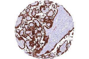Placenta showing a strong cytoplasmic and nuclear PAI2 staining of trophoblast cells