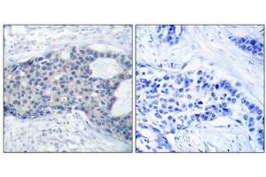 Immunohistochemical analysis of paraffin-embedded human breast carcinoma tissue using Zap-70(Phospho-Tyr493) Antibody(left) or the same antibody preincubated with blocking peptide(right). (ZAP7 (pTyr493) antibody)