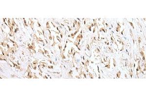 Immunohistochemistry of paraffin-embedded Human prost ate cancer tissue using ZNF34 Polyclonal Antibody at dilution of 1:40(x200)