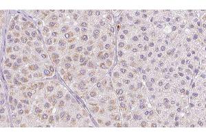 ABIN6277683 at 1/100 staining Human melanoma tissue by IHC-P. (PLAT antibody  (C-Term))