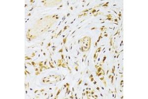 Immunohistochemistry of paraffin-embedded human gastric cancer using RPL13 Antibody (ABIN2559760) at dilution of 1:100 (40x lens). (RPL13 antibody)