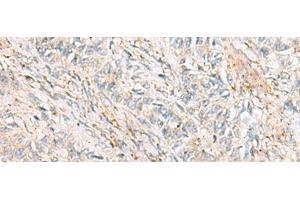 Immunohistochemistry of paraffin-embedded Human ovarian cancer tissue using HBZ Polyclonal Antibody at dilution of 1:120(x200) (HBZ antibody)
