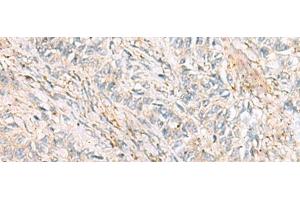 Immunohistochemistry of paraffin-embedded Human ovarian cancer tissue using HBZ Polyclonal Antibody at dilution of 1:120(x200) (HBZ antibody)