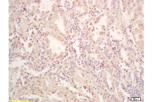 Formalin-fixed and paraffin embedded human gastric carcinoma labeled with Rabbit Anti FES Polyclonal Antibody, Unconjugated (ABIN714191) at 1:200 followed by conjugation to the secondary antibody and DAB staining (FES antibody  (AA 121-220))