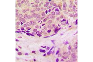 Immunohistochemical analysis of RPL37 staining in human breast cancer formalin fixed paraffin embedded tissue section. (RPL37 antibody  (Center))