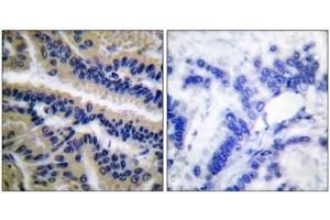 Immunohistochemical analysis of paraffin-embedded human lung carcinoma tissue, using Caspase 9 (cleaved-Asp353) antibody. (Caspase 9 antibody  (Cleaved-Asp353))