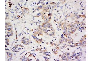 Formalin-fixed and paraffin embedded human breast carcinoma labeled with Anti-ZNF703 Polyclonal Antibody, Unconjugated  at 1:500 followed by conjugation to the secondary antibody and DAB staining. (ZNF703 antibody  (AA 221-320))