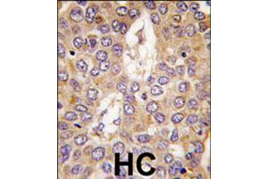 Formalin-fixed and paraffin-embedded human hepatocellular carcinoma reacted with CSNK1G2 polyclonal antibody  , which was peroxidase-conjugated to the secondary antibody, followed by DAB staining. (Casein Kinase 1 gamma 2 antibody  (C-Term))