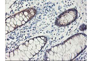 Immunohistochemical staining of paraffin-embedded Human colon tissue using anti-FABP2 mouse monoclonal antibody. (FABP2 antibody)