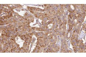 ABIN6267112 at 1/100 staining Human thyroid cancer tissue by IHC-P. (Doublecortin antibody  (pSer297))