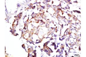Formalin-fixed and paraffin embedded human lung cancer labeled with Rabbit Anti-BDKRB1 Polyclonal Antibody, Unconjugated  at 1:200 followed by conjugation to the secondary antibody and DAB staining (BDKRB1 antibody  (AA 161-260))