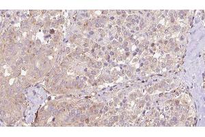ABIN6273319 at 1/100 staining Human thyroid cancer tissue by IHC-P.