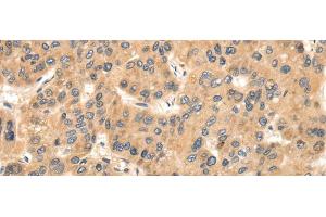 Immunohistochemistry of paraffin-embedded Human liver cancer using TTC23 Polyclonal Antibody at dilution of 1/35 (TTC23 antibody)