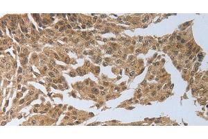 Immunohistochemistry of paraffin-embedded Human cervical cancer using PSMD6 Polyclonal Antibody at dilution of 1:40 (PSMD6 antibody)