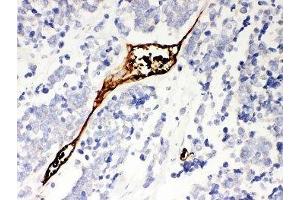 IHC-P: Mesothelin antibody testing of human lung cancer tissue