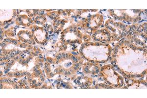 Immunohistochemistry of paraffin-embedded Human thyroid cancer tissue using PROS1 Polyclonal Antibody at dilution 1:60 (PROS1 antibody)
