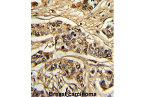 Formalin-fixed and paraffin-embedded human breast carcinomareacted with FREQ polyclonal antibody , which was peroxidase-conjugated to the secondary antibody, followed by AEC staining.