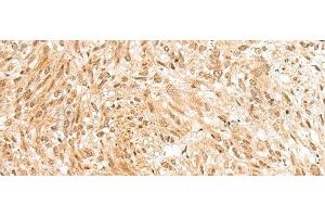 Immunohistochemistry of paraffin-embedded Human liver cancer tissue using RBM19 Polyclonal Antibody at dilution of 1:45(x200) (RBM19 antibody)