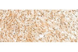 Immunohistochemistry of paraffin-embedded Human liver cancer tissue using RBM19 Polyclonal Antibody at dilution of 1:45(x200)