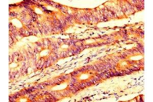 IHC image of ABIN7174328 diluted at 1:500 and staining in paraffin-embedded human colon cancer performed on a Leica BondTM system.