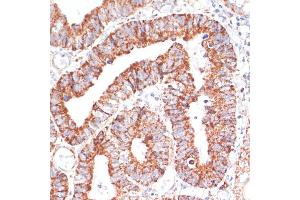 Immunohistochemistry of paraffin-embedded human colon carcinoma using MRPL46 antibody (ABIN7268574) at dilution of 1:100 (40x lens). (MRPL46 antibody  (AA 1-279))