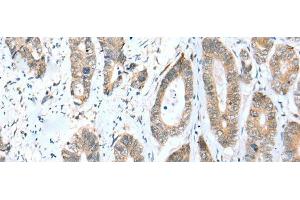 Immunohistochemistry of paraffin-embedded Human gastric cancer tissue using ACBD4 Polyclonal Antibody at dilution of 1:30(x200) (ACBD4 antibody)