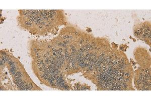 Immunohistochemistry of paraffin-embedded Human colon cancer tissue using PRDM14 Polyclonal Antibody at dilution 1:30 (PRDM14 antibody)