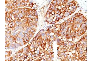 Formalin-fixed, paraffin-embedded human Melanoma stained with Melanoma Marker Mouse Monoclonal (DT101+ BC199 + T311 + HMB45). (Melanoma Marker (MART-1 + Tyrosinase + Gp100) antibody)
