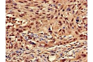 Immunohistochemistry of paraffin-embedded human lung cancer using ABIN7157380 at dilution of 1:100 (Cytokeratin 13 antibody  (AA 420-458))