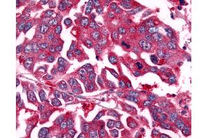 Anti-NEK7 antibody IHC of human Colon, Carcinoma. (NEK7 antibody  (Kinase Domain))