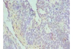 Immunohistochemistry of paraffin-embedded human endometrial cancer using ABIN7172842 at dilution of 1:100 (TGFBI antibody  (AA 30-250))