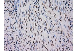 Immunohistochemical staining of paraffin-embedded Carcinoma of kidney tissue using anti-MRI1mouse monoclonal antibody. (MRI1 antibody)