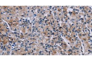 Immunohistochemistry of paraffin-embedded Human prostate cancer using KDM4D Polyclonal Antibody at dilution of 1:50 (JMJD2D antibody)
