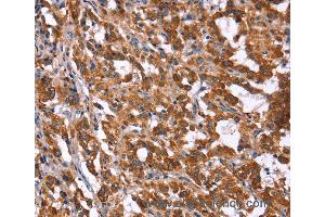 Immunohistochemistry of Human gastric cancer using HACE1 Polyclonal Antibody at dilution of 1:40 (HACE1 antibody)