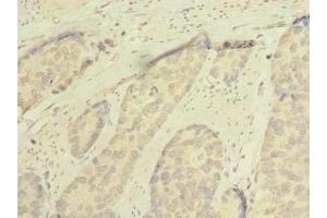 Immunohistochemistry of paraffin-embedded human gastric cancer using ABIN7168953 at dilution of 1:100 (C7orf45 antibody  (AA 56-244))