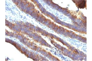 Formalin-fixed, paraffin-embedded human Colon Carcinoma stained with MUC3 Mouse Monoclonal Antibody (M3. (MUC3A antibody)