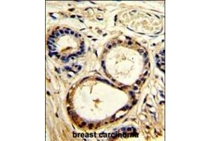 Formalin-fixed and paraffin-embedded human breast carcinoma with SRC8 Antibody (N-term), which was peroxidase-conjugated to the secondary antibody, followed by DAB staining. (SRC8 antibody  (N-Term))