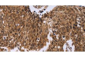 Immunohistochemistry of paraffin-embedded Human cervical cancer tissue using ERCC6L Polyclonal Antibody at dilution 1:30 (ERCC6L antibody)
