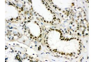 Anti- EWSR1 Picoband antibody, IHC(P) IHC(P): Human Mammary Cancer Tissue (EWSR1 antibody  (Middle Region))