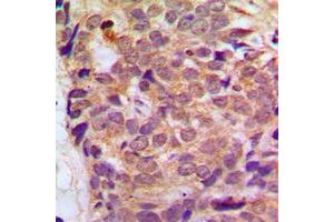 Immunohistochemical analysis of RGS10 staining in human breast cancer formalin fixed paraffin embedded tissue section.